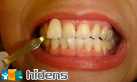 牙齒美白案例一:周小姐41年次 牙齒美白案例一:周小姐41年次