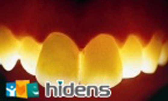 假牙(牙套)種類 假牙(牙套)種類