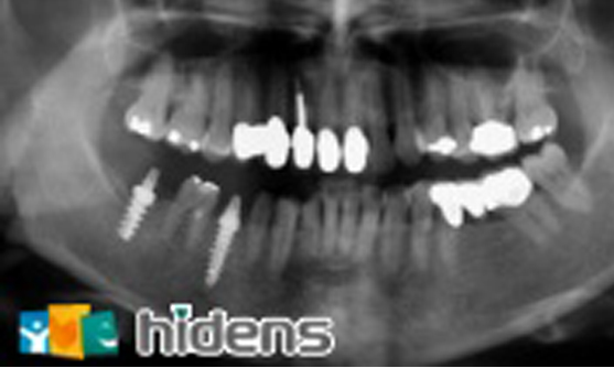 植牙案例二:阮小姐 植牙案例二:阮小姐