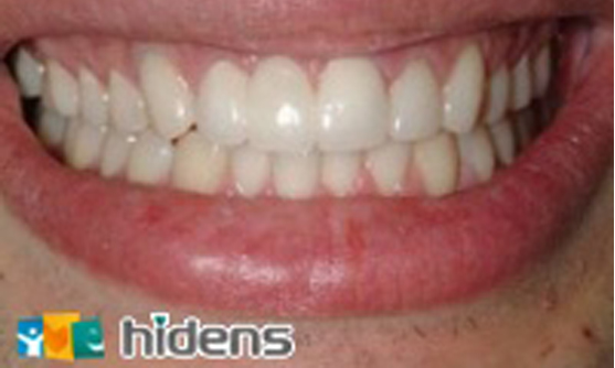 假牙案例